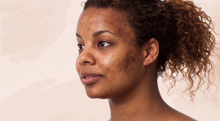 Woman Acne Scars