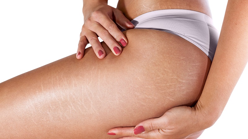 Effective Ways To Remove Stretch Marks