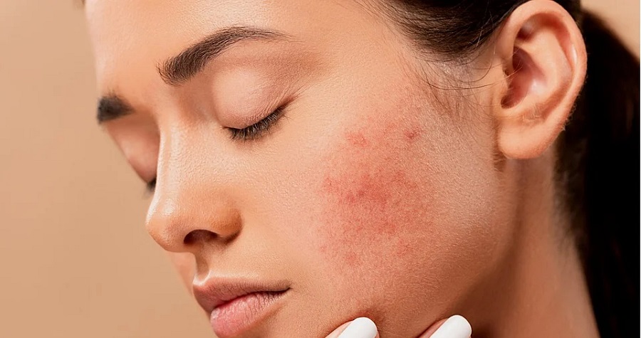 4 Effective Ways To Fade Adult Acne Scarring Fpn 