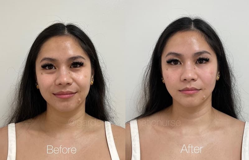 Undereye Filler Image