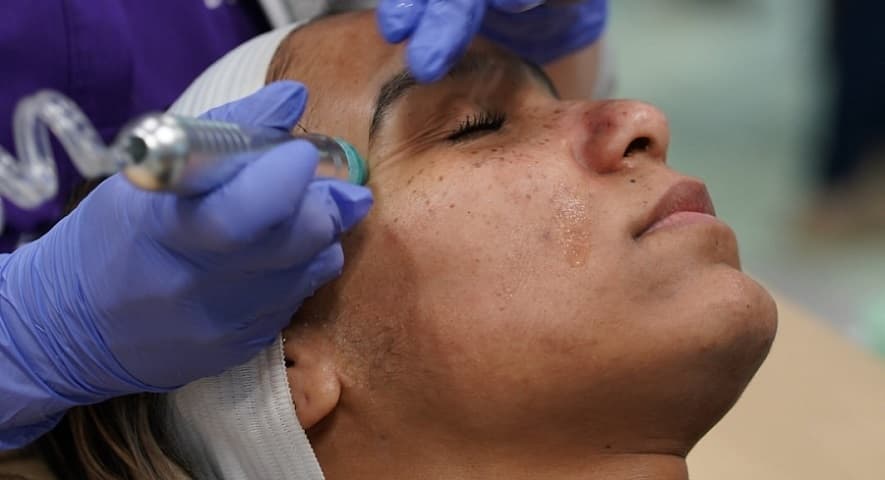 Woman undergoing RF Microneedling Treatment Photo