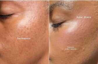 acne scar and dark spot on face - Fashion Police Nigeria