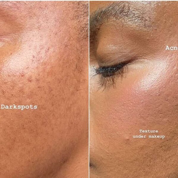 acne scar and dark spot on face - Fashion Police Nigeria