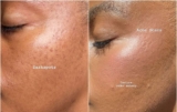 Dark Spots vs Acne Scars: What’s The Big Difference?