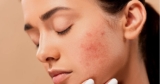 4 Effective Ways To Fade Adult Acne Scarring